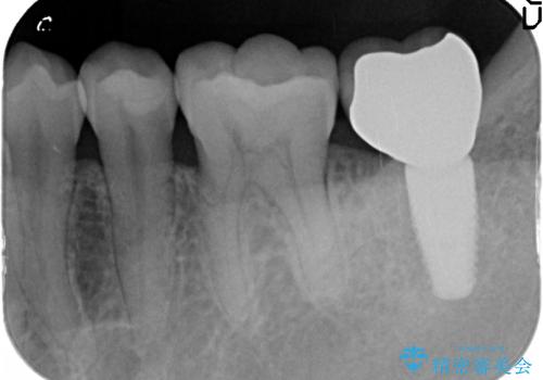 [straumann implant] 薄くなった歯牙の破折　インプラントによる咬合回復の治療後