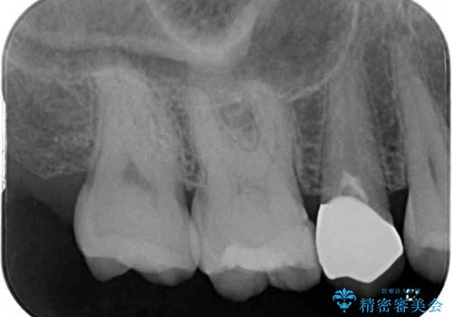 大きなむし歯のセラミッククラウン　神経を取り除かずに保存の治療後