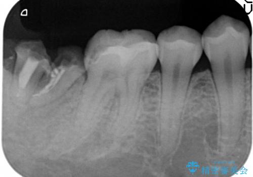 30代女性　奥歯のショートインプラントの治療前