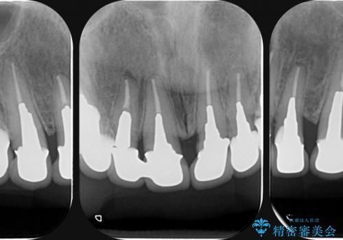 [歯ぐきからの出血]　歯肉の状態を改善する前歯オールセラミック治療①の治療前