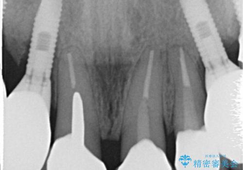 40代女性　「前歯が浮いている」　土台ごと折れた前歯の修復　の治療前