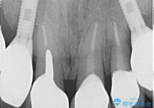 40代女性　「前歯が浮いている」　土台ごと折れた前歯の修復　の治療後