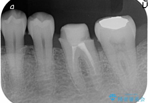 治療途中の歯の補綴の治療前