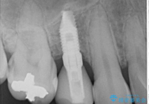 30代男性　歯が無い→インプラントで回復　サイナスソケットリフトの併用の治療後