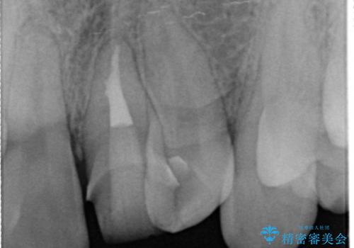 [外傷歯の治療] ころんでぶつけて折れた前歯の審美回復の治療中