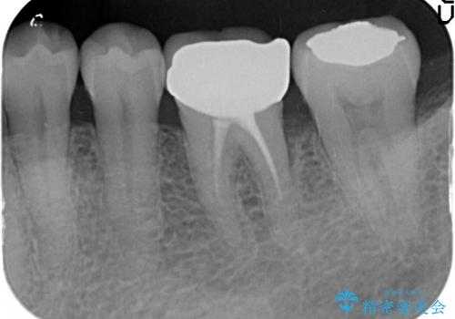 治療途中の歯の補綴の治療後