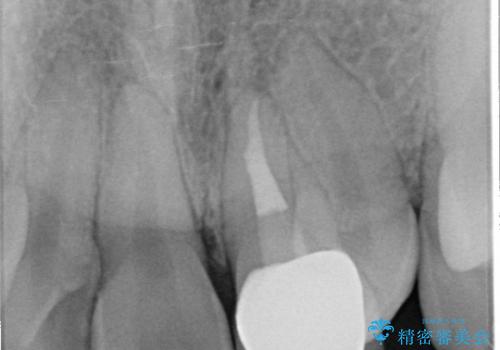[外傷歯の治療] ころんでぶつけて折れた前歯の審美回復の治療後