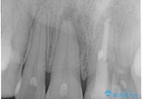 前歯の根管治療(イニシャルトリートメント)の治療前