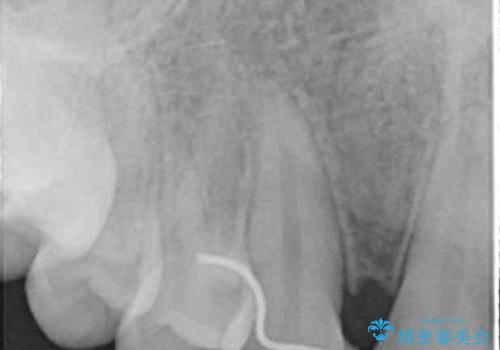 尖った犬歯を目立たなくする　ラミネートベニア修復　他院の矯正治療で前歯の隙間が残ったのを回復の治療後