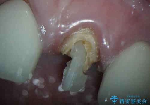 40代女性　「前歯が浮いている」　土台ごと折れた前歯の修復　