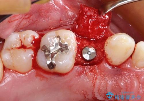 30代男性　歯が無い→インプラントで回復　サイナスソケットリフトの併用の治療中