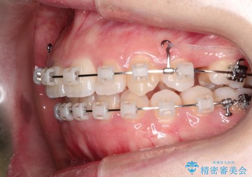 20代女性　最新の拡大装置を併用した抜歯・ワイヤー矯正の治療中