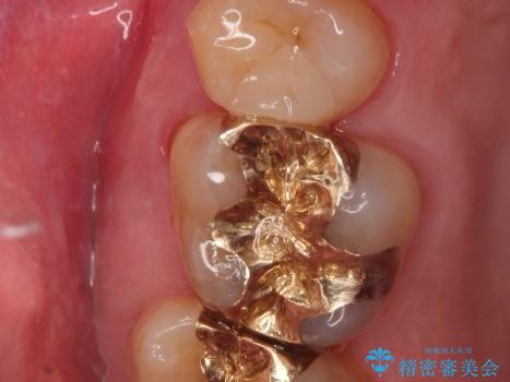 虫歯になっている歯の補綴と適合の悪いかぶせ物の再補綴の症例 治療後