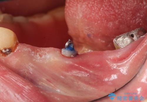 噛めないところをインプラントに、残せない歯を残す治療の治療前