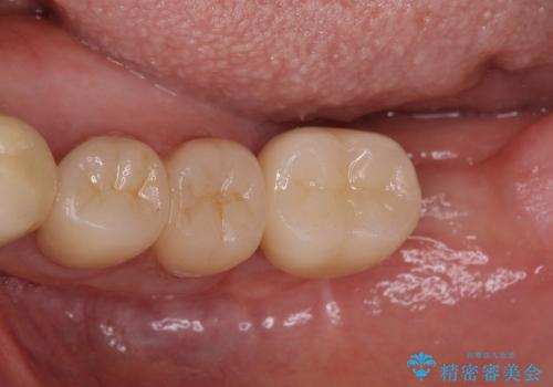 奥歯の審美治療　ストローマンインプラントとカスタムアバットメントの治療後