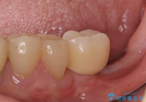 奥歯の審美治療　ストローマンインプラントとカスタムアバットメントの治療後