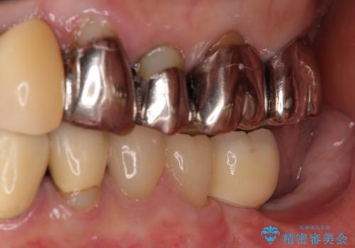 奥歯の審美治療　ストローマンインプラントとカスタムアバットメントの症例 治療後