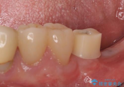 奥歯の審美治療　ストローマンインプラントとカスタムアバットメントの治療中