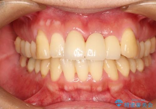 前歯のブリッジ治療　部分矯正を併用して歯茎の形態をコントロールの症例 治療後