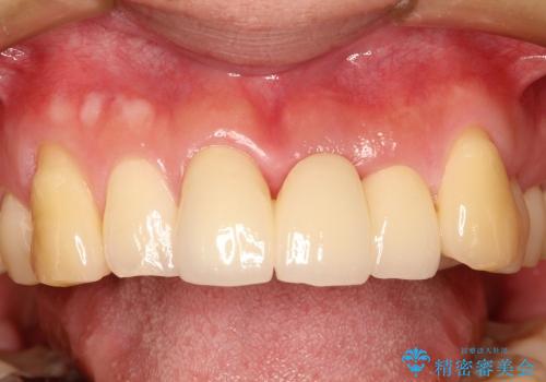前歯のブリッジ治療　部分矯正を併用して歯茎の形態をコントロールの治療後