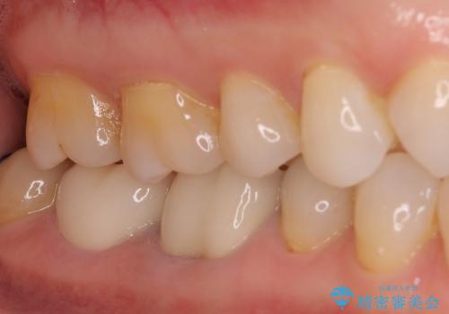 奥歯が痛い　大きな虫歯治療と根管治療の症例 治療後