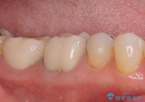 奥歯が痛い　大きな虫歯治療と根管治療