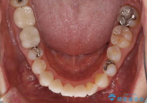 奥歯が痛い　大きな虫歯治療と根管治療の治療後