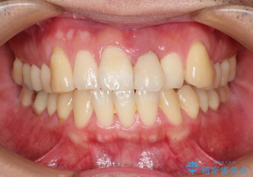 前歯のブリッジ治療　部分矯正を併用して歯茎の形態をコントロールの症例 治療前