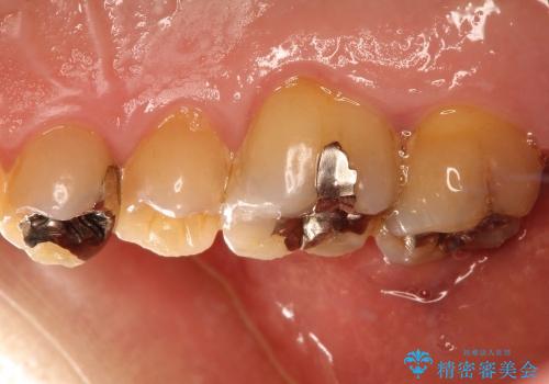 虫歯になっている歯の補綴と適合の悪いかぶせ物の再補綴の治療前