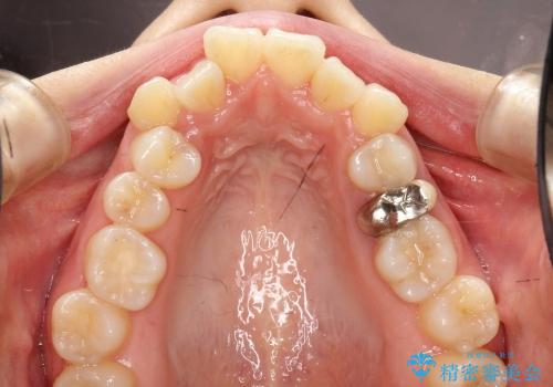 20代女性　最新の拡大装置を併用した抜歯・ワイヤー矯正の治療前