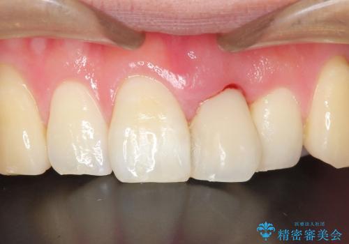 前歯のブリッジ治療　部分矯正を併用して歯茎の形態をコントロールの治療前