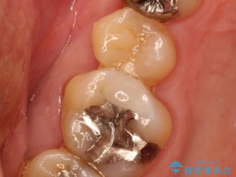 虫歯になっている歯の補綴と適合の悪いかぶせ物の再補綴の治療前