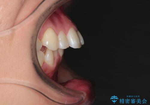 口が閉じにくい　ハーフリンガルの抜歯矯正で口元スッキリの症例 治療前