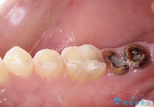 30代女性　奥歯のショートインプラントの症例 治療前