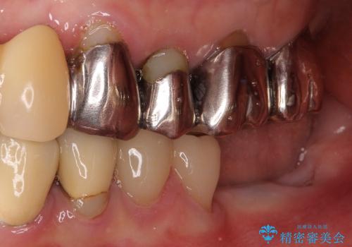 奥歯の審美治療　ストローマンインプラントとカスタムアバットメントの治療前