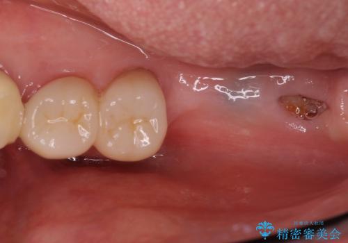 奥歯の審美治療　ストローマンインプラントとカスタムアバットメントの治療前