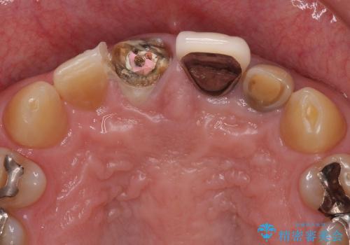 前歯の被せものがとれた　メタルボンドからオールセラミッククラウンへの治療前