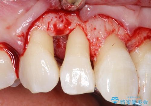 30代女性　前歯の限局的な歯周病を治療する①～再生治療の治療中