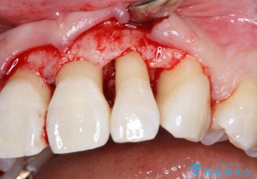 30代女性　前歯の限局的な歯周病を治療する①～再生治療の治療中
