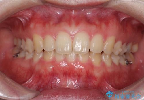 インビザラインによる出っ歯とすきっ歯の改善の治療中