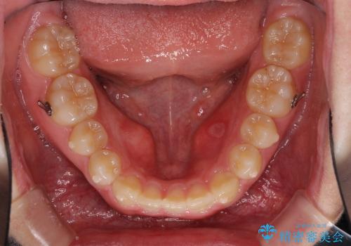 インビザラインによる出っ歯とすきっ歯の改善の治療中