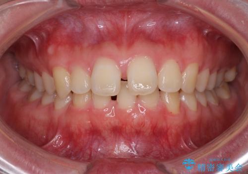 インビザラインによる出っ歯とすきっ歯の改善