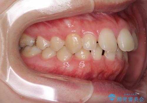インビザラインによる出っ歯とすきっ歯の改善の治療前