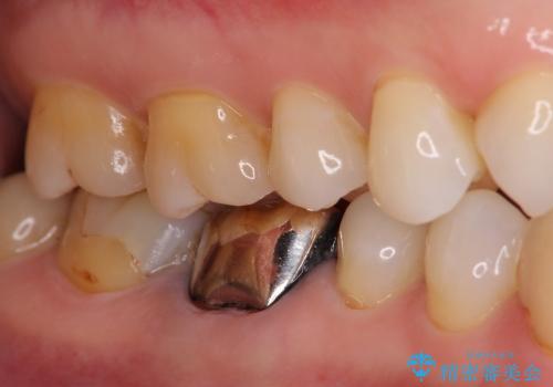 奥歯が痛い　大きな虫歯治療と根管治療の症例 治療前