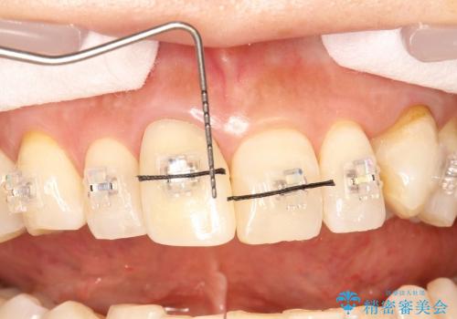 30代女性　部分矯正を駆使して歯ぐきのラインと歯軸をそろえるの治療中