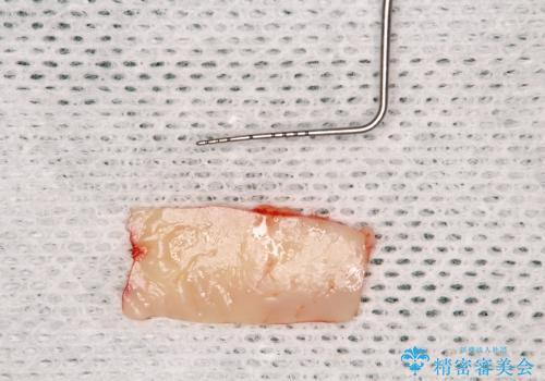 40代女性　奥歯のインプラントと分岐部病変の処置(ルートセパレーション)～インプラントと歯肉移植の治療中