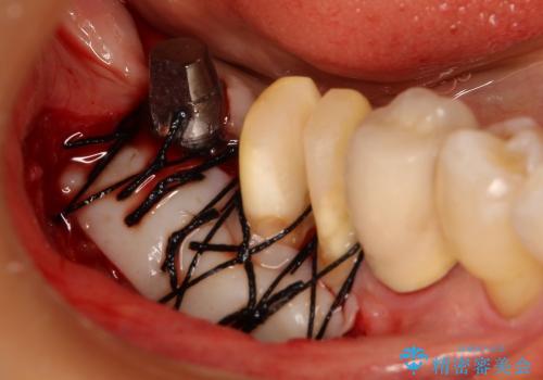 40代女性　奥歯のインプラントと分岐部病変の処置(ルートセパレーション)～インプラントと歯肉移植