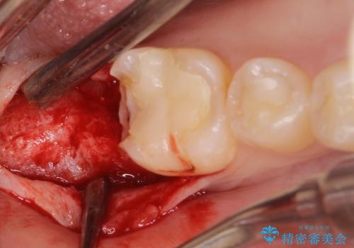 30代女性　奥歯のショートインプラントの治療中