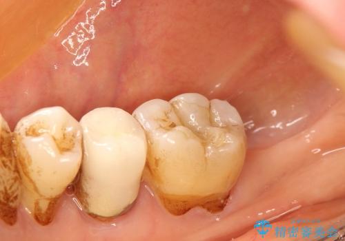 40代女性　奥歯のインプラントと分岐部病変の処置(ルートセパレーション)の治療前