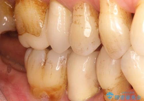 40代女性　奥歯のインプラントと分岐部病変の処置(ルートセパレーション)の症例 治療前